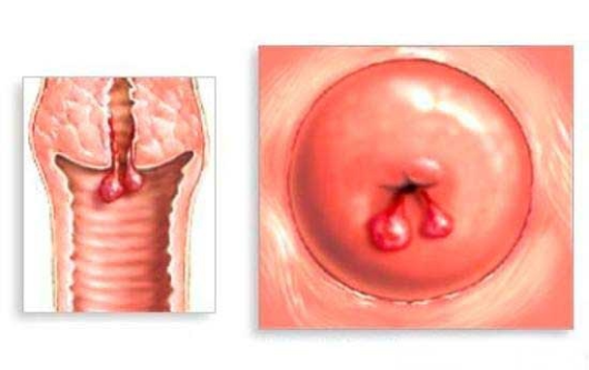 Các bệnh phụ khoa gây khí hư màu nâu bạn cần biết