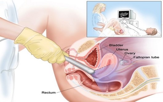 Siêu âm sản phụ khoa đầu dò âm đạo