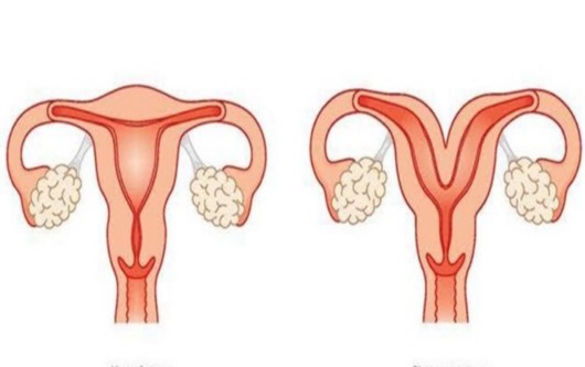 Một số điều cần biết về tử cung hai sừng