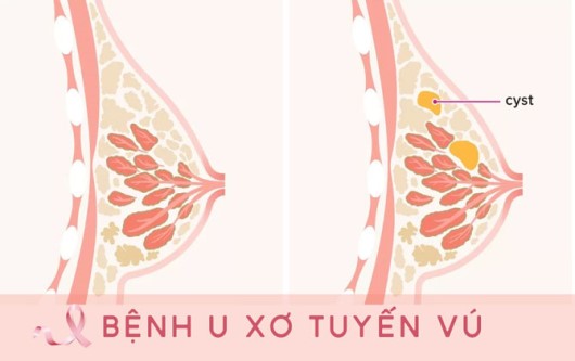 U xơ tuyến vú và những điều cần biết