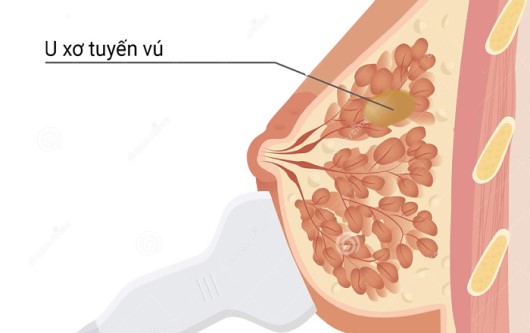 U xơ tuyến vú và những điều cần biết