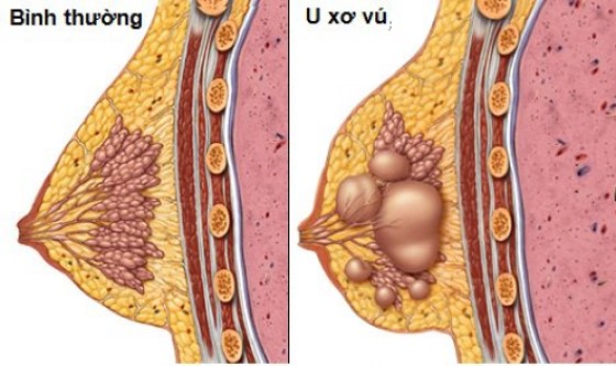 Bệnh u xơ tuyến vú và những điều cần biết