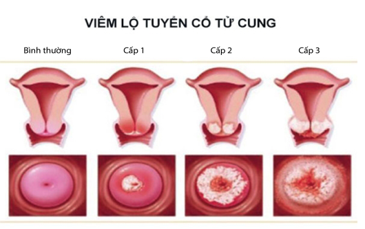 Các bệnh phụ khoa gây khí hư màu nâu bạn cần biết
