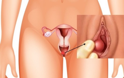 Cách điều trị viêm tuyến bartholin