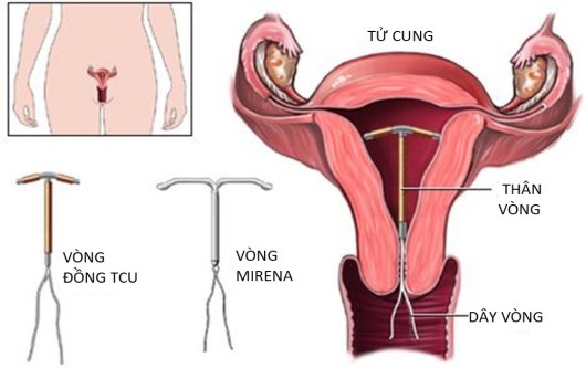 Nên đặt vòng tránh thai vào ngày bao nhiêu của kì kinh?