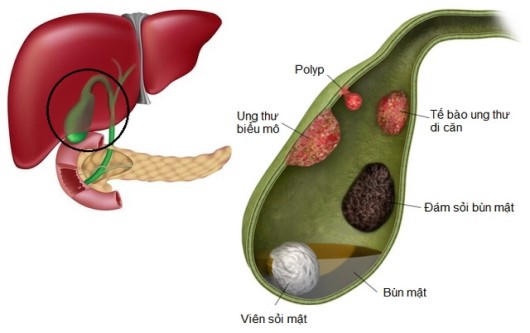 polyp túi mật khi mang thai