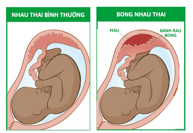 rau bong non