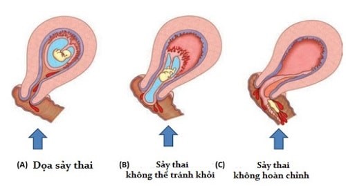 sẩy thai liên tiếp