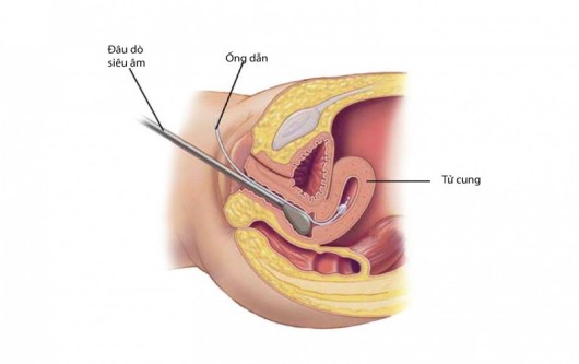 polyp buồng tử cung