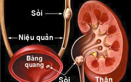 viêm thận bể thận cấp