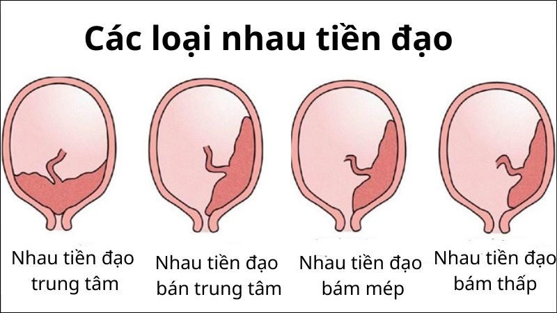 sót nhau thai, sót nhau, sau sinh, nhau tiền đạo