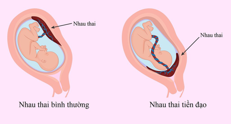 sót nhau thai, sót nhau, sau sinh