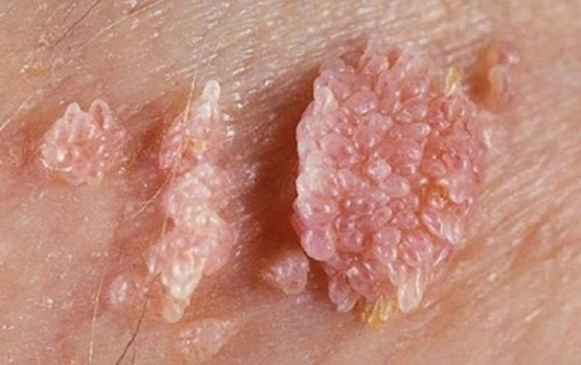 sùi mào gà, HPV, mụn cóc sinh dục, phụ nữ mang thai bị sùi mào gà