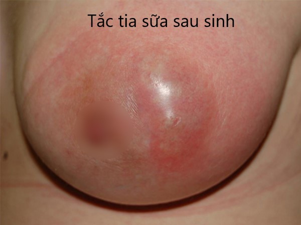 tắc tia sữa sau sinh