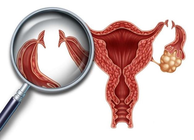 Triệt sản nữ - thắt ống dẫn trứng