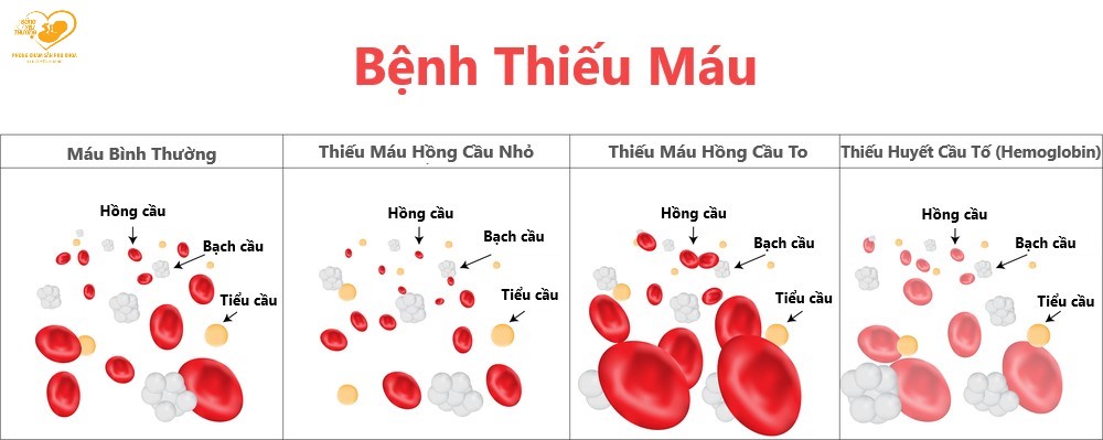 thiếu máu khi mang thai