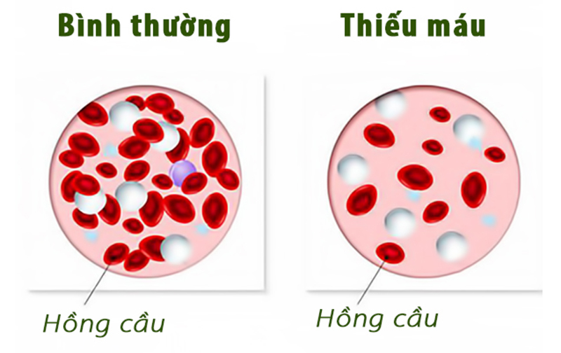 Thực phẩm dinh dưỡng cho trẻ thiếu máu