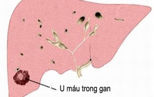 u máu trong gan