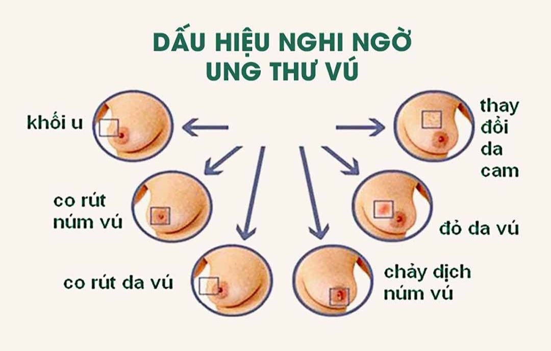 ung thư vú