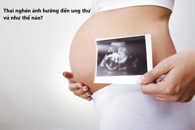 ung thư vú