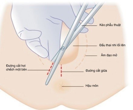 vết khâu tầng sinh môn