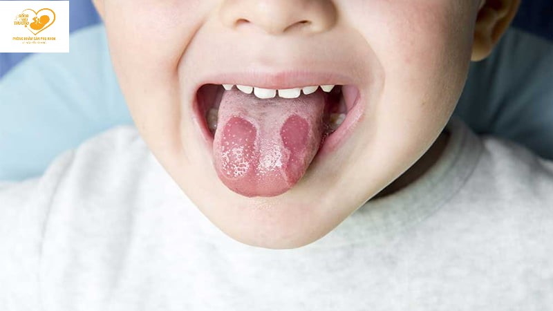 viêm lưỡi bản đồ