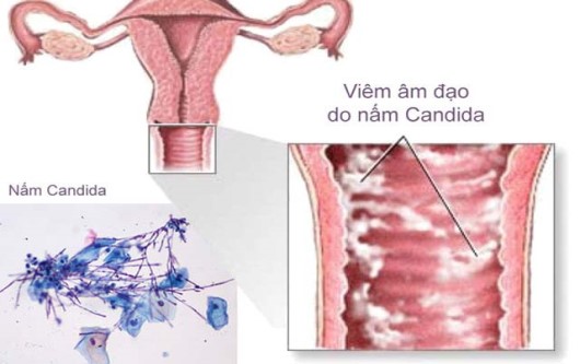 viêm âm đạo