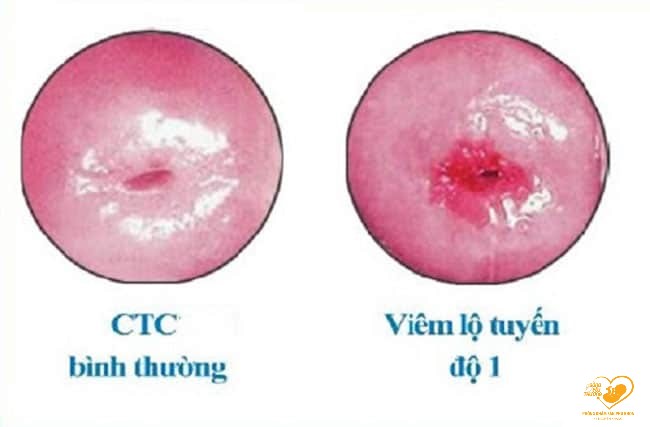 viêm lộ tuyến cổ tử cung cấp độ 1