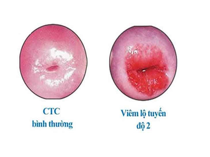 viêm lộ tuyến cổ tử cung cấp độ 2