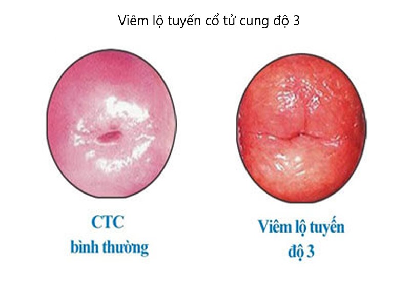 Viêm lộ tuyến cổ tử cung độ 3