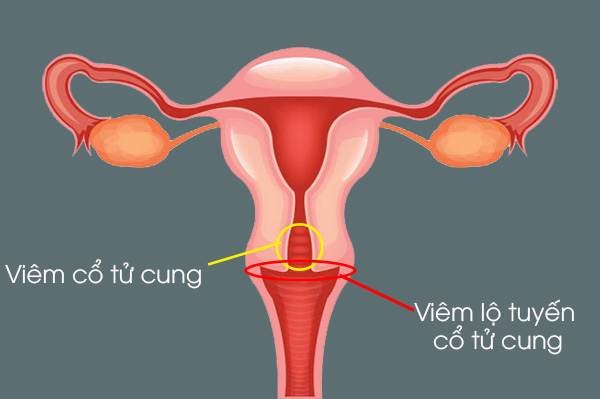 viêm lộ tuyến