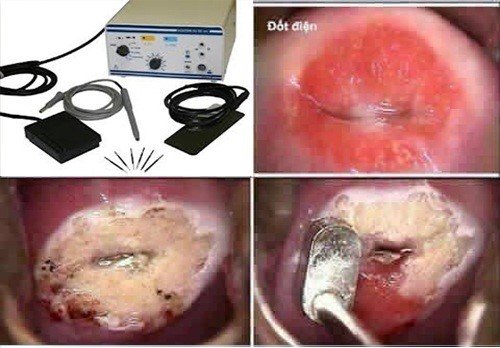 viêm lộ tuyến