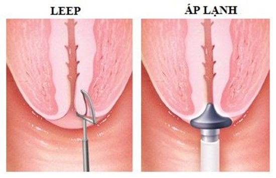 viêm lộ tuyến