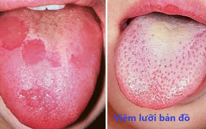 viêm lưỡi bản đồ