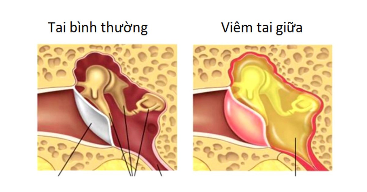 viêm tai giữa
