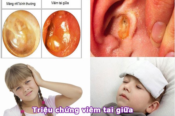 viêm tai giữa
