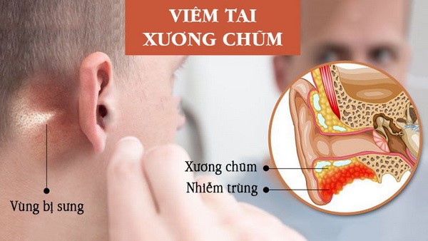 viêm tai giữa