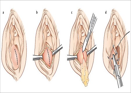 viêm tuyến bartholin vỡ mủ