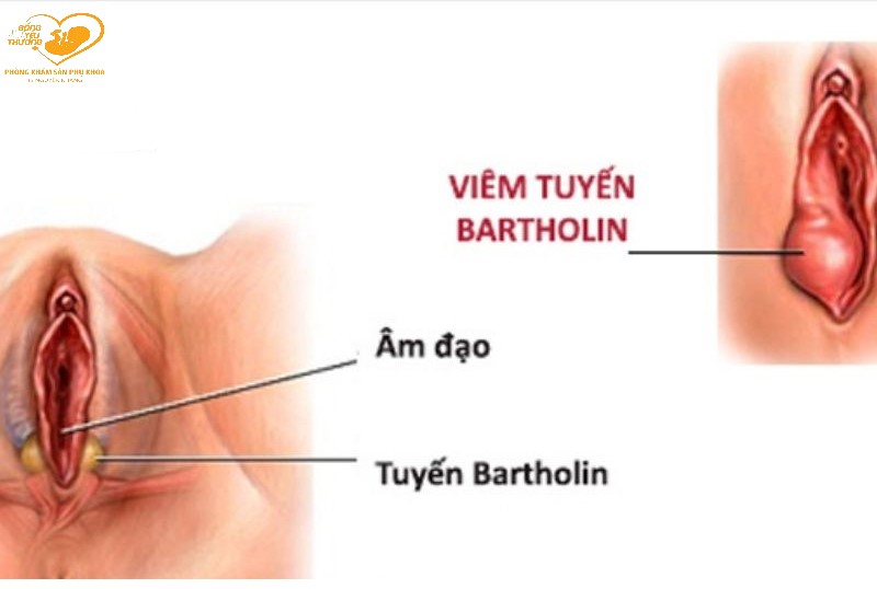 viêm tuyến bartholin vỡ mủ