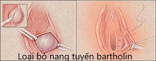 điều trị viêm tuyến bartholin