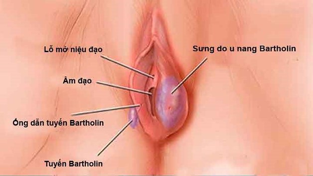 triệu chứng viêm tuyến bartholin