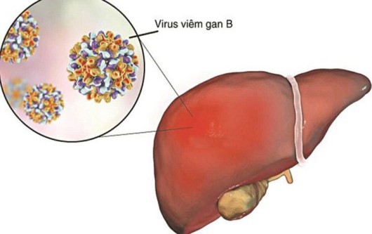 viêm gan b